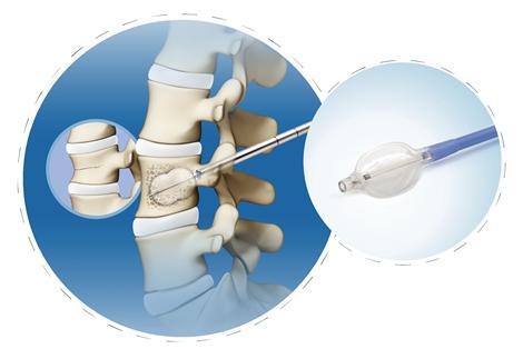 【博彩平台】椎体扩张球囊导管(PKP)